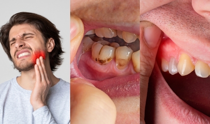 متى تحتاج إلى حشو عصب؟